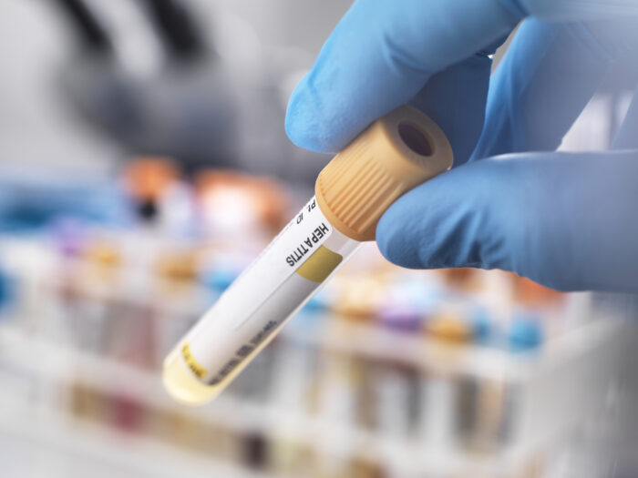 Medical technician preparing a human sample for hepatitis testing