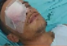 Jovem fura olho do namorado com furadeira após ser agredida com soco