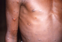 Vigilância em Saúde do Amazonas ( FVS ) alerta sobre caso suspeito de Varíola dos Macacos em Manaus