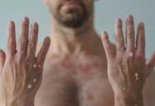 Primeiro caso de varíola dos macacos é confirmado no Amazonas