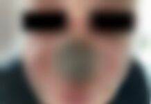 Varíola dos macacos: nariz de homem apodrece antes de receber diagnóstico; imagens fortes