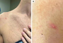 Sobe para 12 o número de casos suspeitos de varíola dos macacos no Amazonas