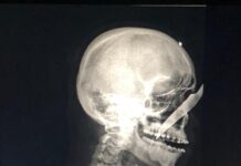 Homem fica com uma faca encravada no nariz no Amazonas