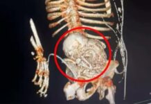 “Grávida por 5 décadas”: idosa descobre feto mumificado há 56 anos no útero