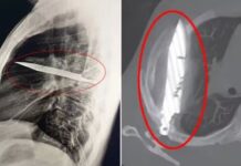 Homem descobre que tem f4c4 alojada no peito após oito anos