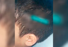 Br1g4 entre colegas de classe, termina com menino de nove anos com lápis cravado na cabeça