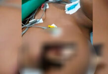 Homem fica com pedaço de madeira alojado próximo ao coração em acidente com árvore em Barcelos