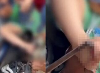 VÍDEO: Menino fica com um pedal de motocicleta atravessa do em seu pé no interior do AM
